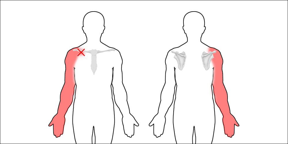 arms affected by thoracic outlet syndrome