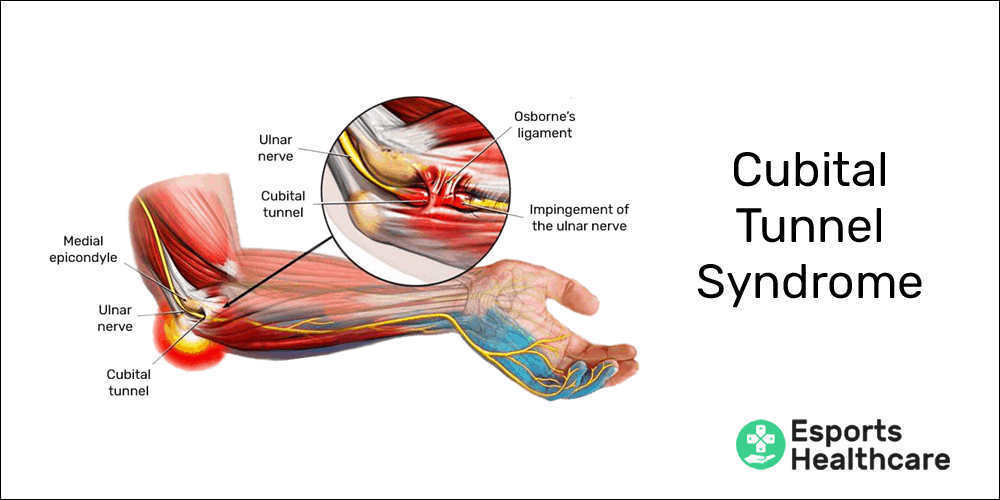 Cubital tunnel syndrome: how you're unknowingly damaging your nerves –  Esports Healthcare