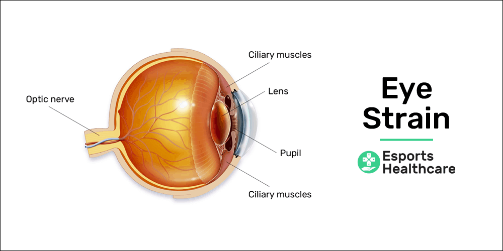 Esports injury - eye strain