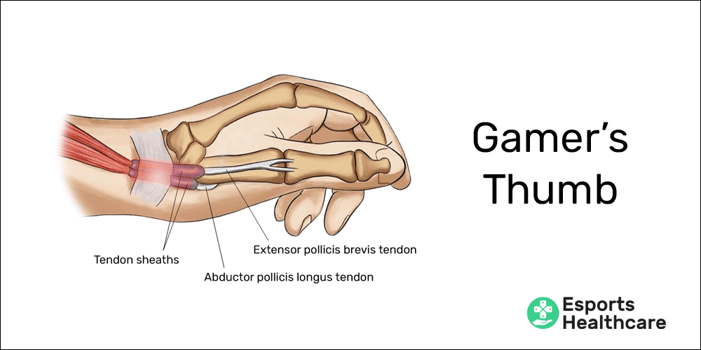 Gamer's thumb