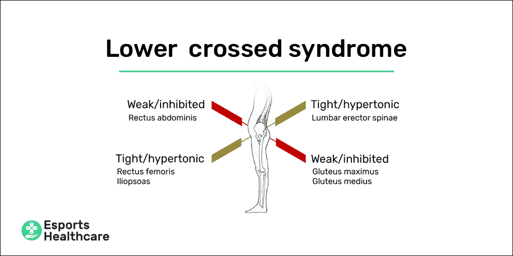 Lower crossed syndrome