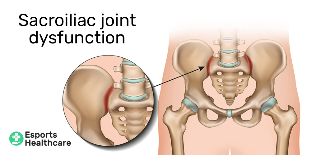Sacroiliac joint dysfunction