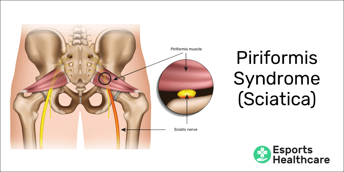 Sciatica in gamers: an undeniable pain in the butt – Esports Healthcare