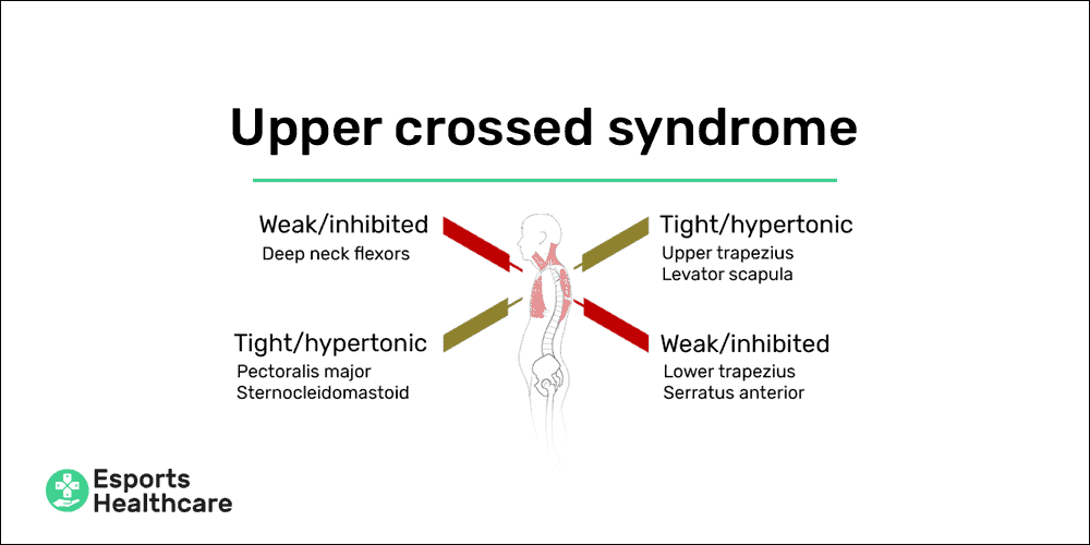Neck pain from gaming upper crossed syndrome